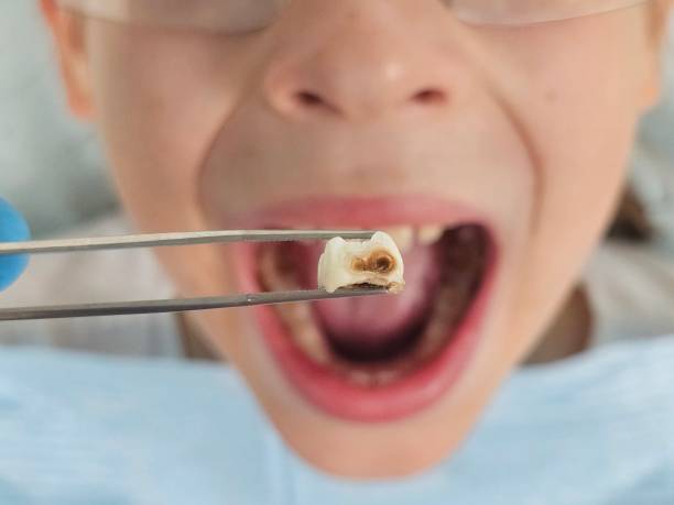 Best Dental Abscess Treatment in South Barrington, IL